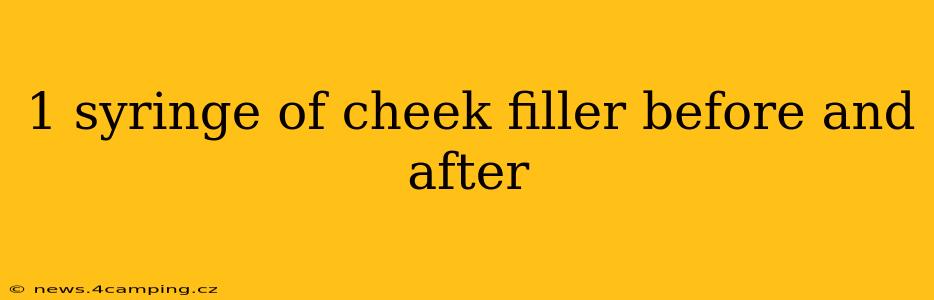 1 syringe of cheek filler before and after