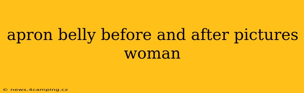 apron belly before and after pictures woman