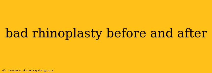 bad rhinoplasty before and after