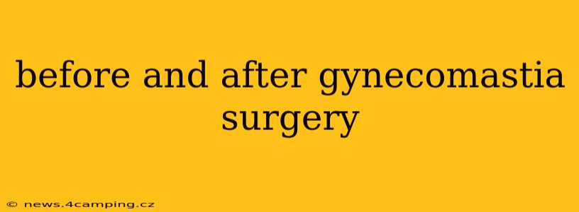 before and after gynecomastia surgery