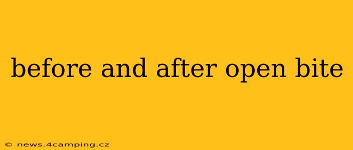before and after open bite