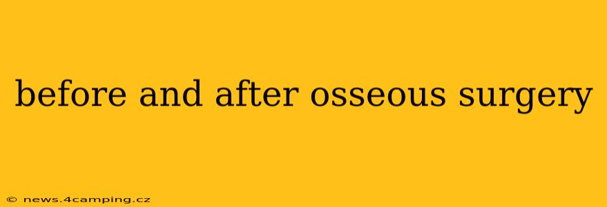 before and after osseous surgery