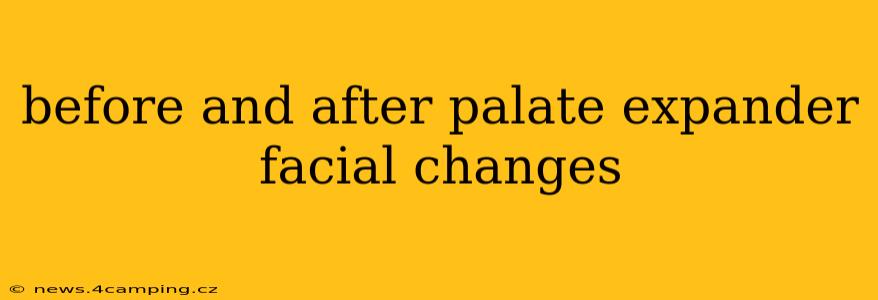 before and after palate expander facial changes
