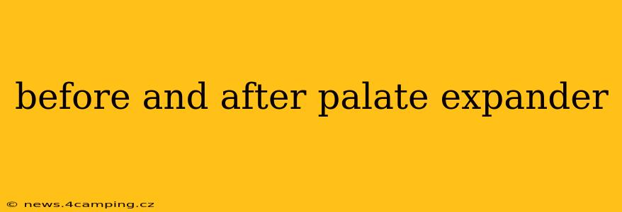 before and after palate expander