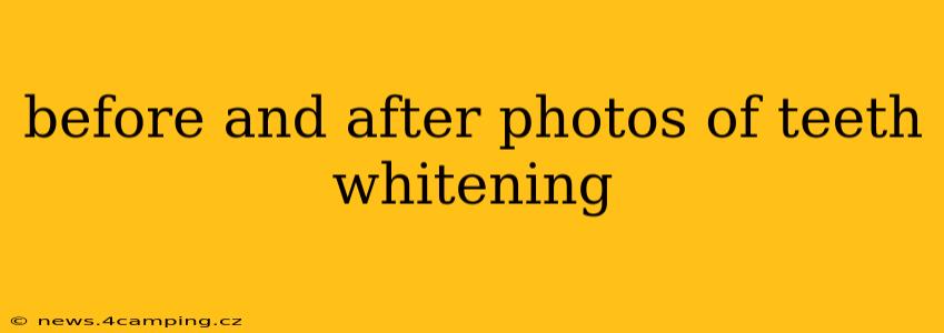 before and after photos of teeth whitening