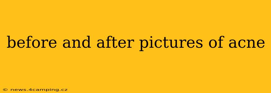 before and after pictures of acne