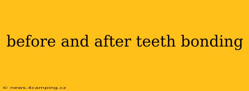 before and after teeth bonding