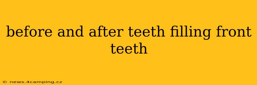 before and after teeth filling front teeth