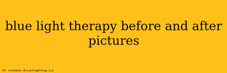 blue light therapy before and after pictures