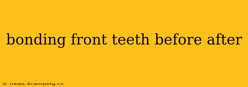 bonding front teeth before after