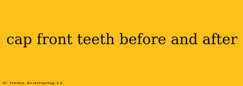 cap front teeth before and after