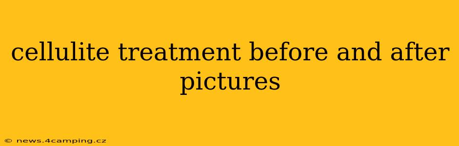 cellulite treatment before and after pictures