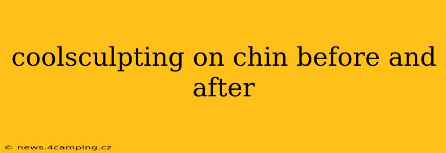 coolsculpting on chin before and after