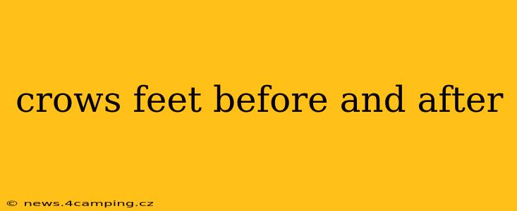 crows feet before and after