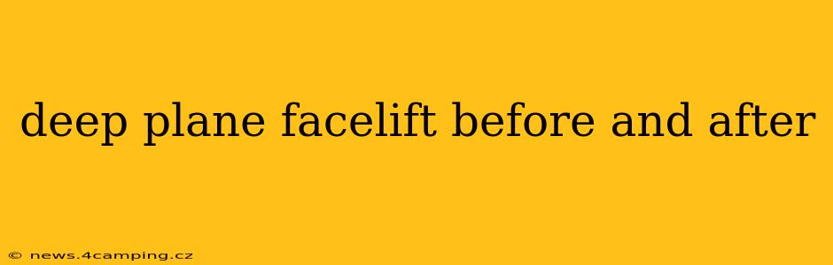 deep plane facelift before and after