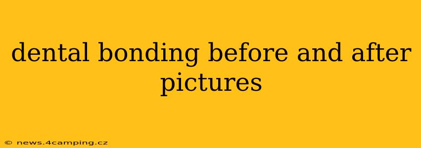 dental bonding before and after pictures