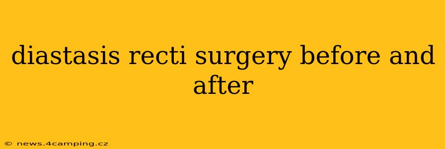 diastasis recti surgery before and after