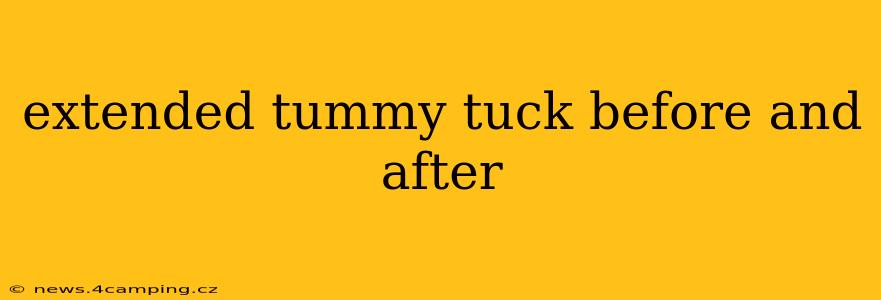 extended tummy tuck before and after