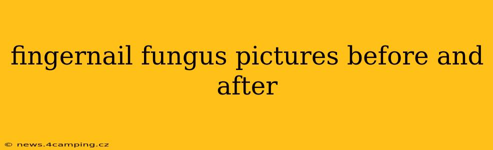 fingernail fungus pictures before and after