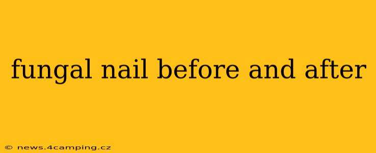 fungal nail before and after