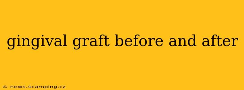 gingival graft before and after