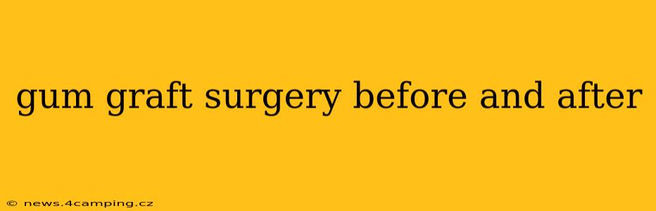 gum graft surgery before and after