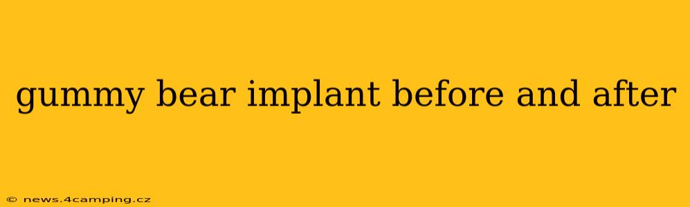 gummy bear implant before and after
