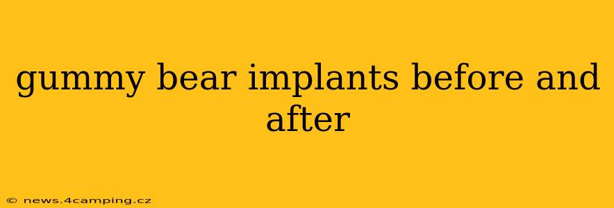 gummy bear implants before and after