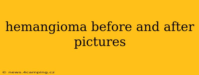 hemangioma before and after pictures
