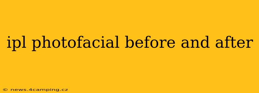 ipl photofacial before and after