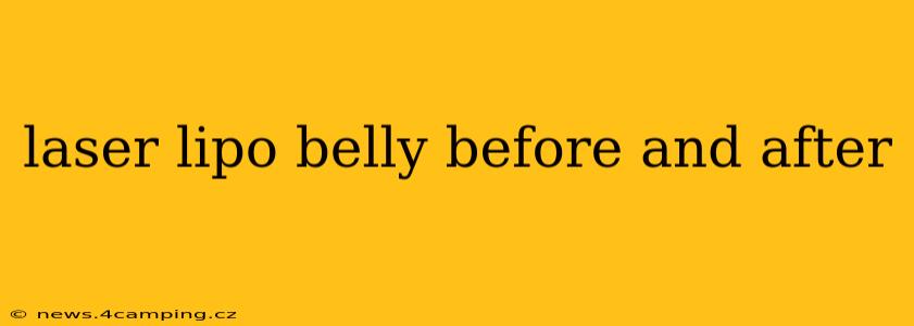 laser lipo belly before and after