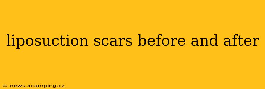 liposuction scars before and after