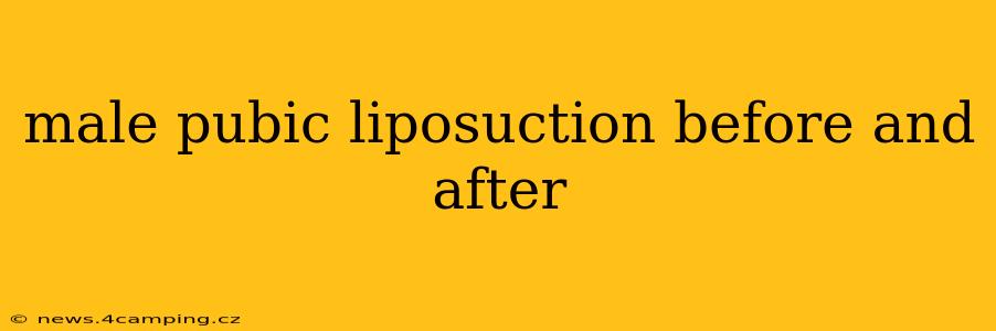 male pubic liposuction before and after