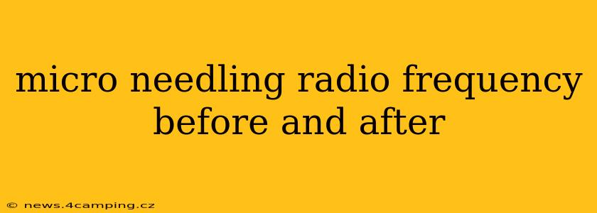 micro needling radio frequency before and after