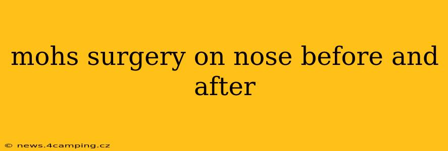 mohs surgery on nose before and after