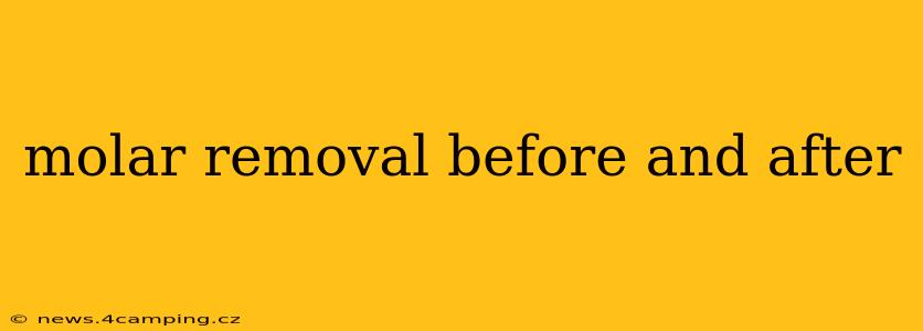 molar removal before and after