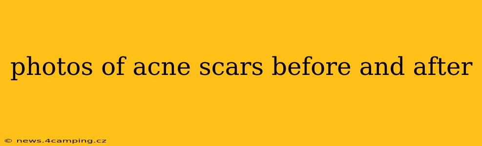 photos of acne scars before and after
