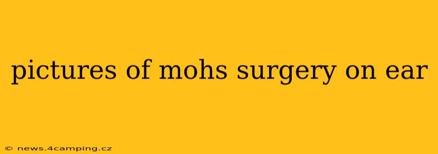 pictures of mohs surgery on ear