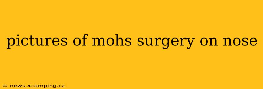 pictures of mohs surgery on nose