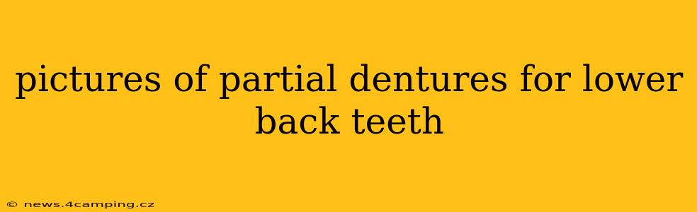 pictures of partial dentures for lower back teeth