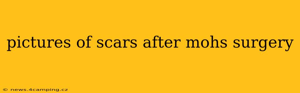 pictures of scars after mohs surgery