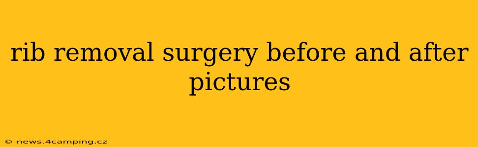 rib removal surgery before and after pictures