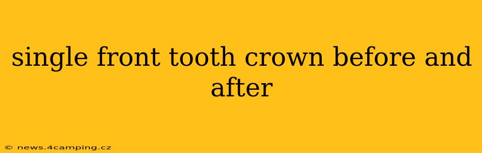 single front tooth crown before and after