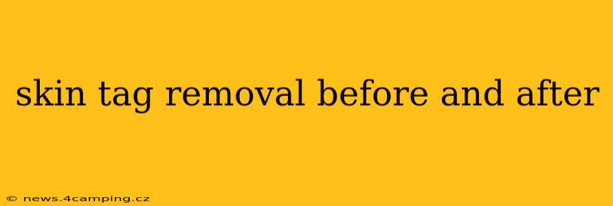 skin tag removal before and after