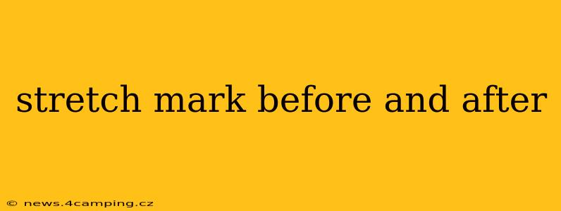 stretch mark before and after