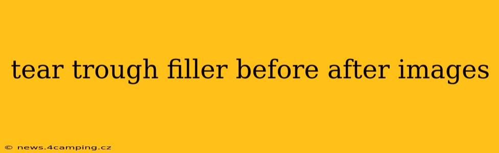 tear trough filler before after images