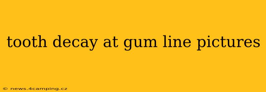 tooth decay at gum line pictures