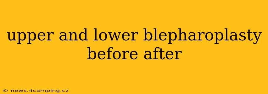 upper and lower blepharoplasty before after