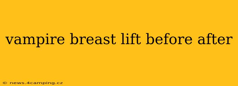 vampire breast lift before after