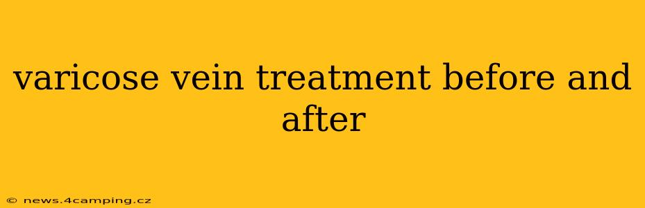 varicose vein treatment before and after